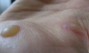 Natural Remedies for Warts
